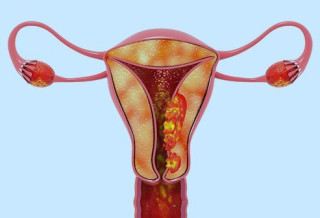 यि महिलालाई हुन्छ पाठेघरको मुखको क्यान्सरको धेरै जोखिम ?